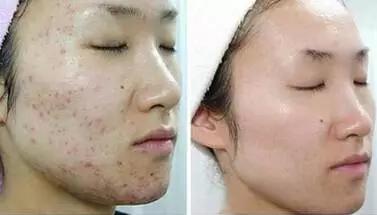 鍋氱編瀹瑰幓姣涘瓟绮夊埡榛戝ご鐥涘悧,鍋氱編瀹圭鐥樺潙