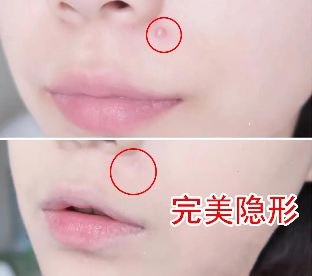 片仔癀痘痘贴效果怎么样,片仔癀清痘系列真的有用嘛