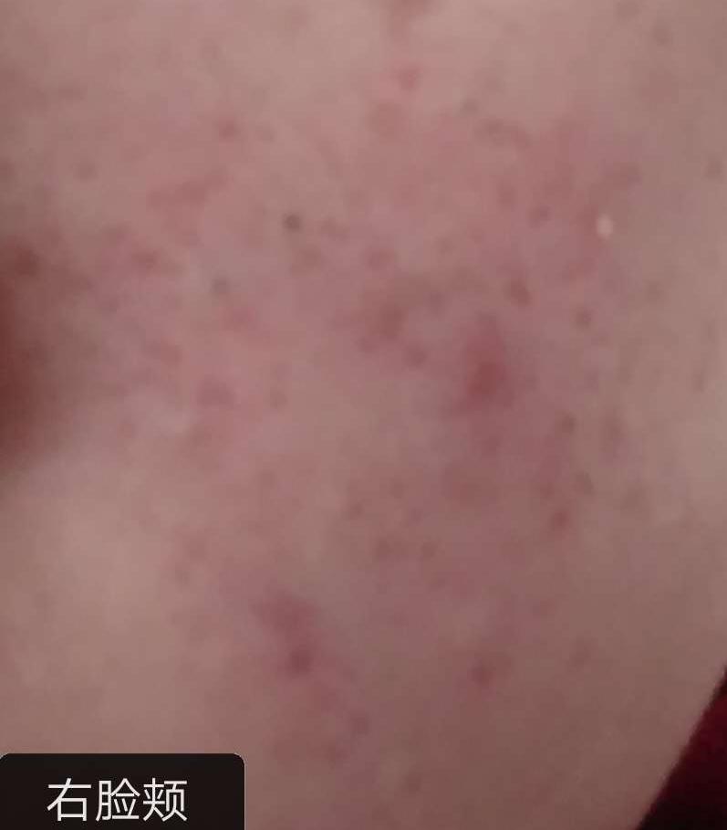 30多岁了脸上还是长痘痘反反复复,脸上反反复复长痘痘是怎么回事