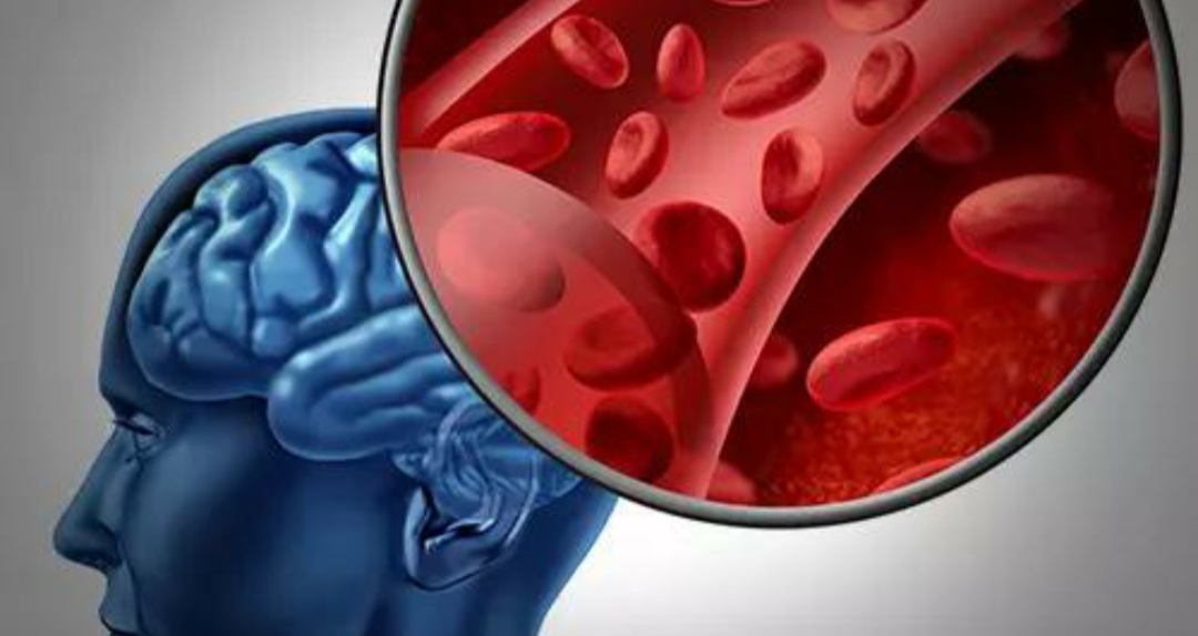 脑小血管病症状有哪些,专家讲解脑小血管病发病机制