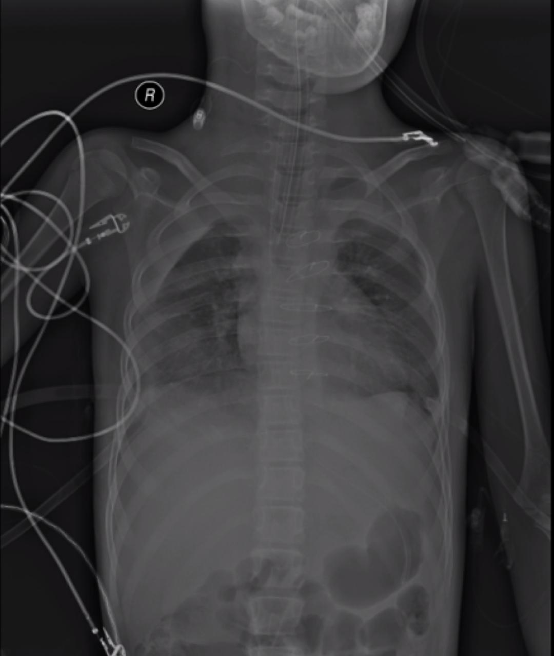 不敢咳嗽如何进行有效排痰,无咳嗽呼吸困难