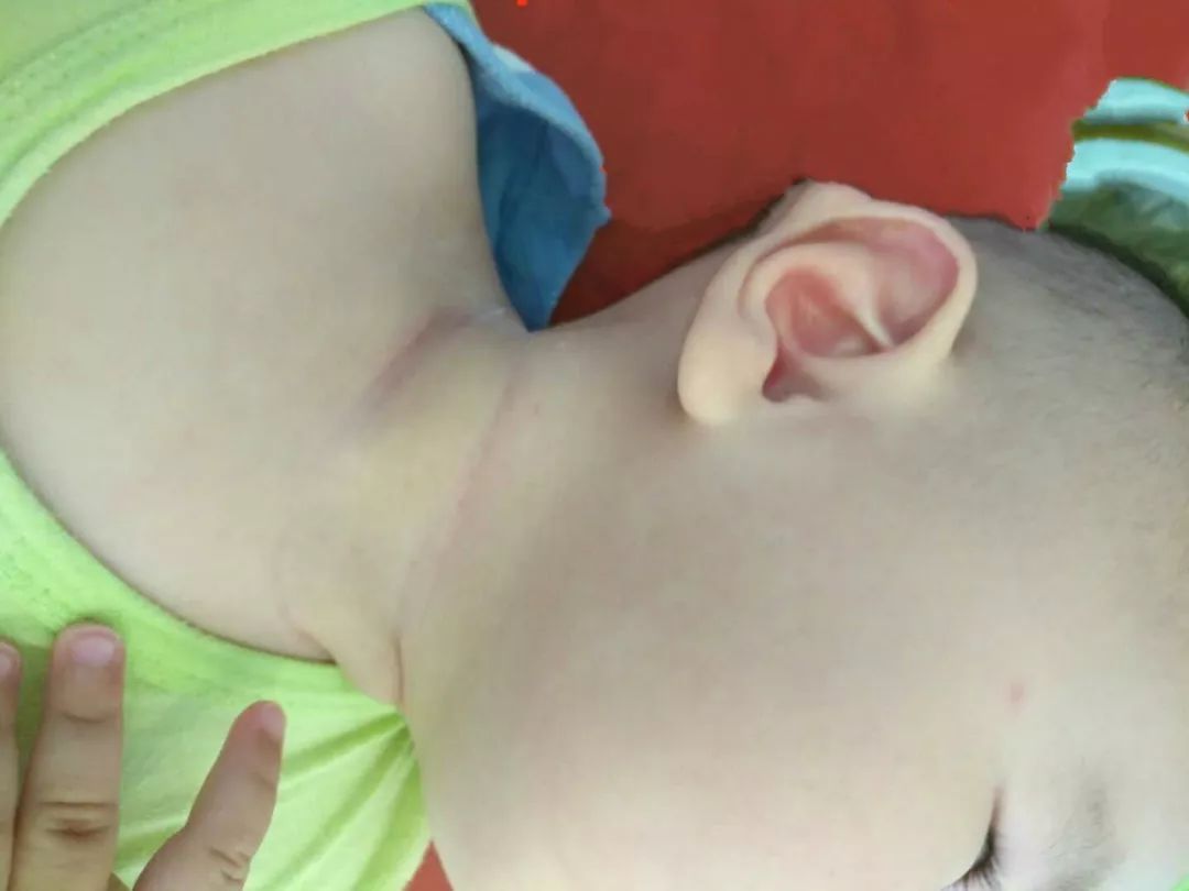 小儿肌性斜颈表现及治疗方案,婴儿肌性斜颈肿块多大算严重