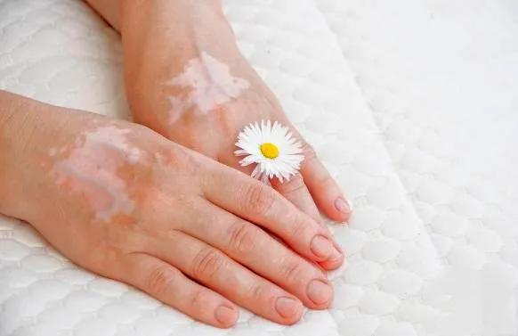 身上长了白癜风怎么办,身上长白癜风是怎么引起的