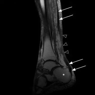 跟腱断裂和前叉损伤,前叉断裂和跟腱断裂哪个严重