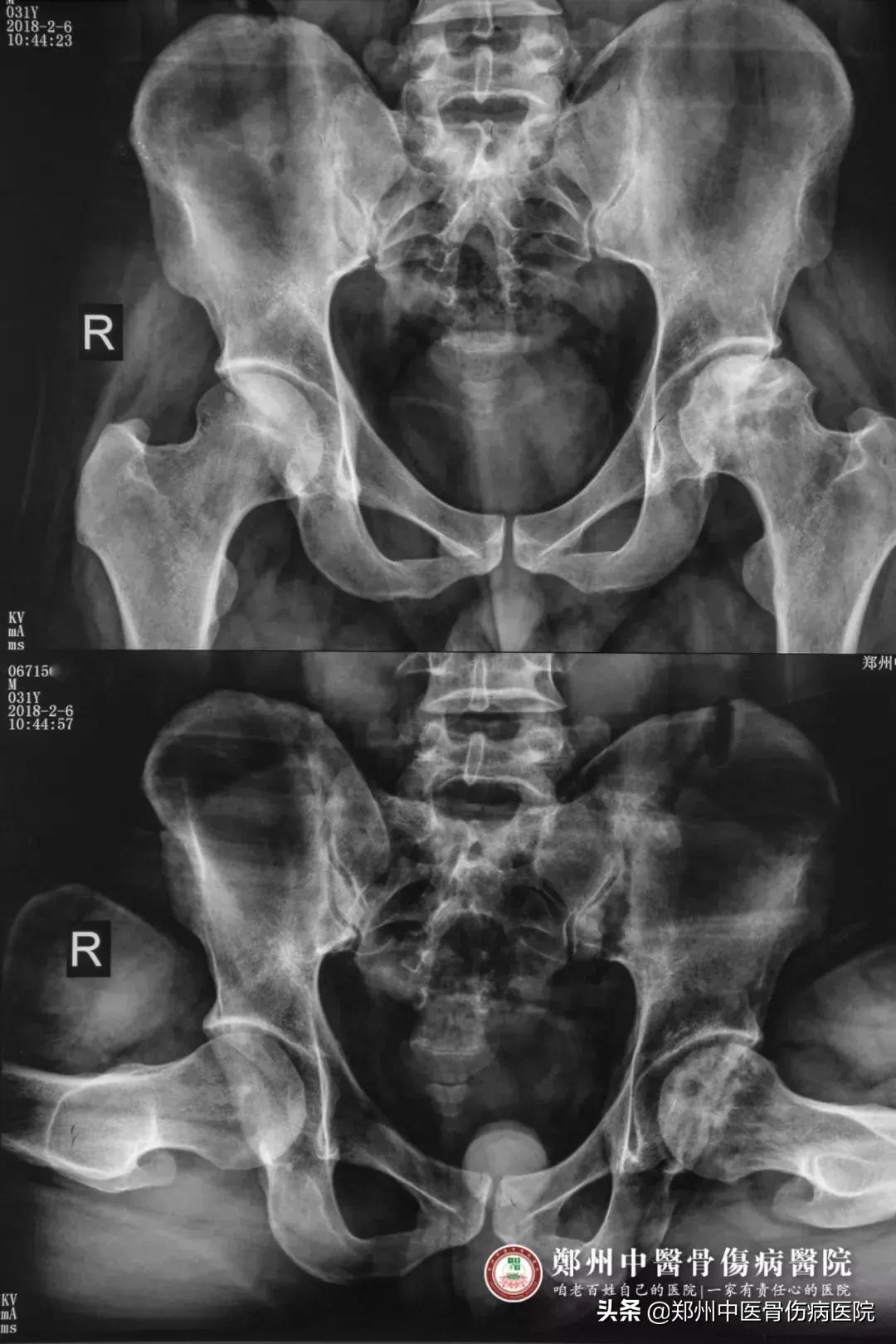 股骨头缺血性坏死有没有奇迹治愈,治愈股骨头坏死需要哪些锻炼