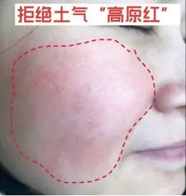 拯救你的歌曲原唱,脸上有高原红怎么拯救