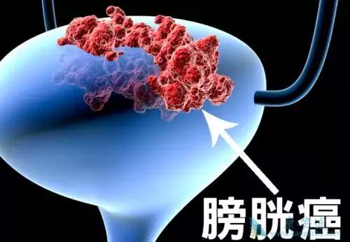 喝豆浆会得乳腺癌、便秘会得肠癌.......这些谣言您信了吗？