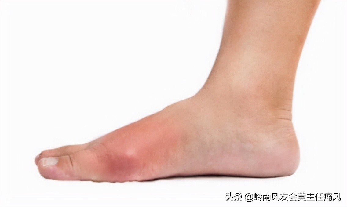 痛风患者做好3件事,做好痛风康复
