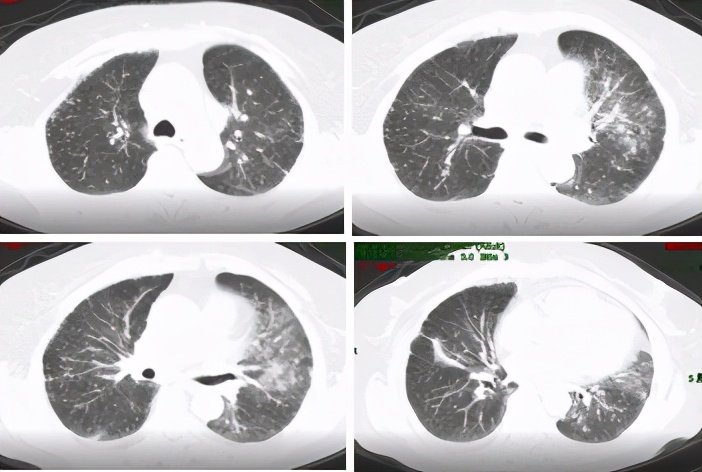 无明显诱因咳嗽、呼吸困难，大量胸腔积液，竟与妇科肿瘤有关？