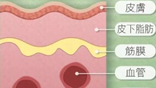 肛周坏死性筋膜炎的死亡率,肛周坏死性筋膜炎的定义