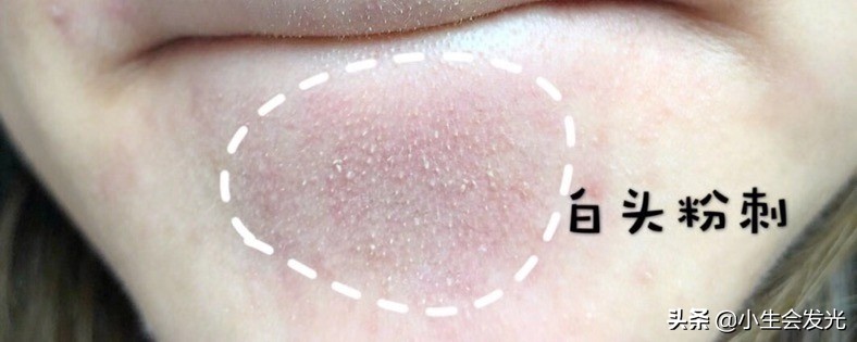 闭合性闭口怎么形成的,闭口怎么成痘痘了