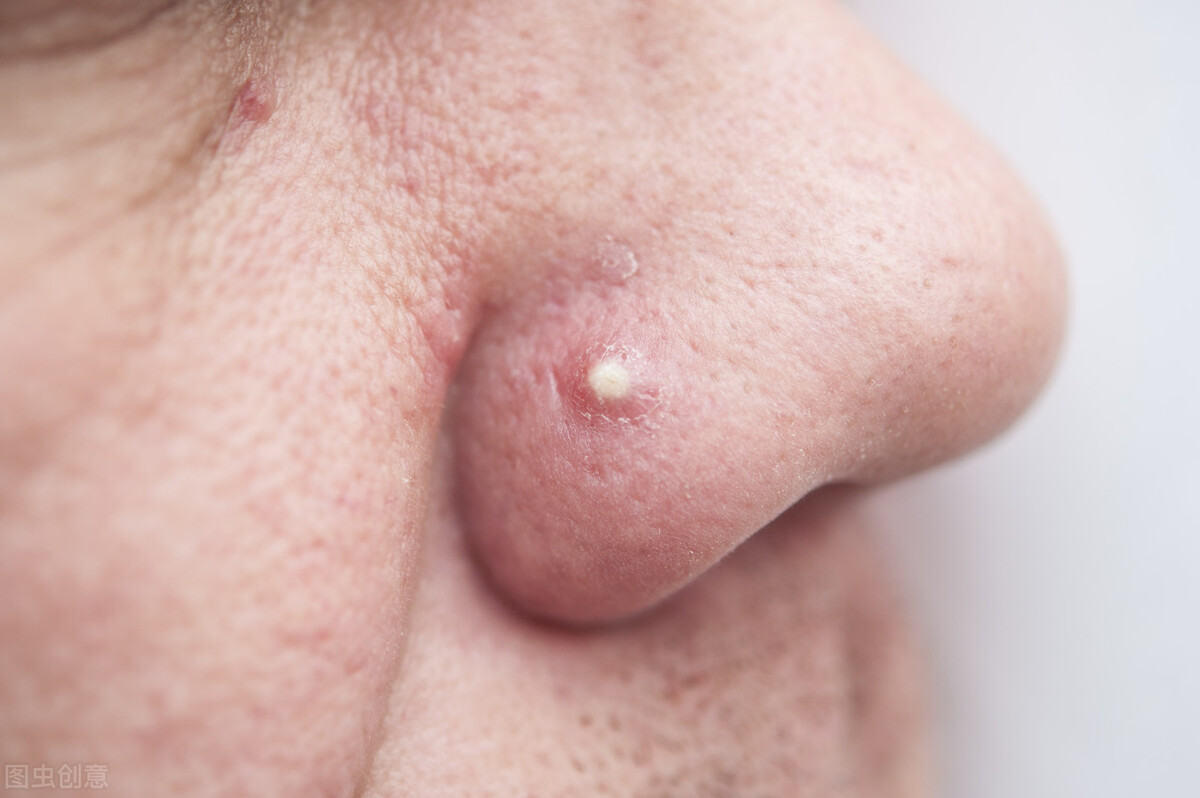 鼻子上挤出的就是螨虫吗,鼻子两边挤出白色的东西是螨虫吗