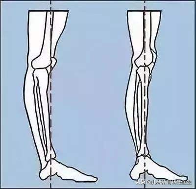 孩子出门玩耍担心牵拉肘？爸爸妈妈看这一篇就够了