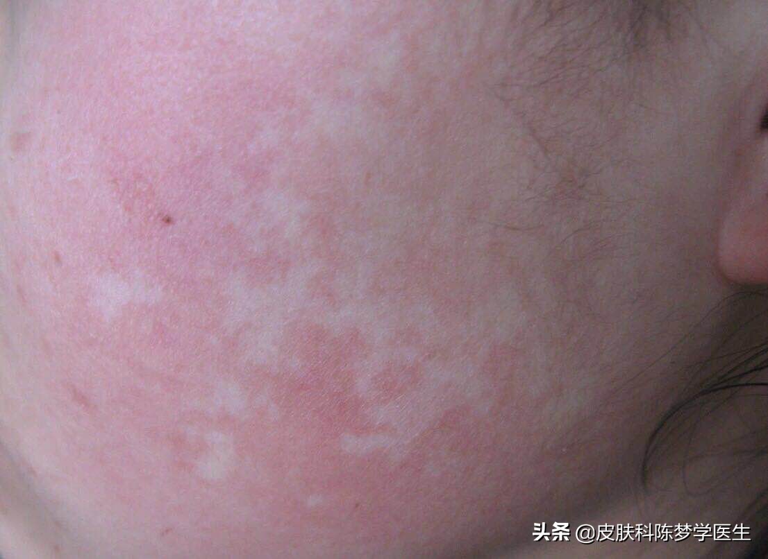 皮肤出现白斑吃什么好,皮肤发现白斑怎么办