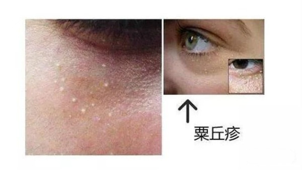 顽固多年黑头闭口毛孔粗大怎么办,南京皮肤病研究所顽固闭口粉刺