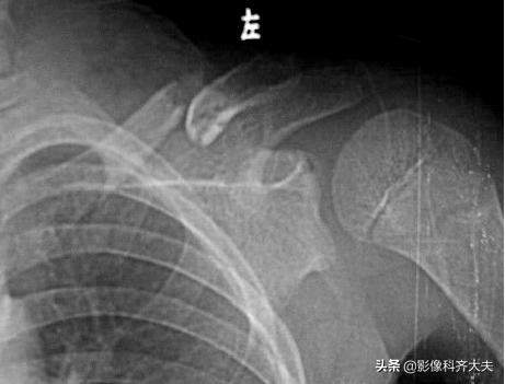 骨折的影像学检查及各自的优势,骨折的影像学愈合标准