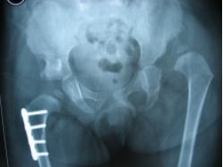 儿童发育性髋脱位表现,发育性髋关节脱位治疗4-7岁