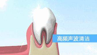 牙齿变黑变黄用什么清洗,牙齿发黄有牙垢用什么牙膏