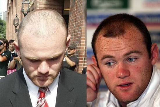 脱发和头发长有关系,脱发导致发际线一直往后拖