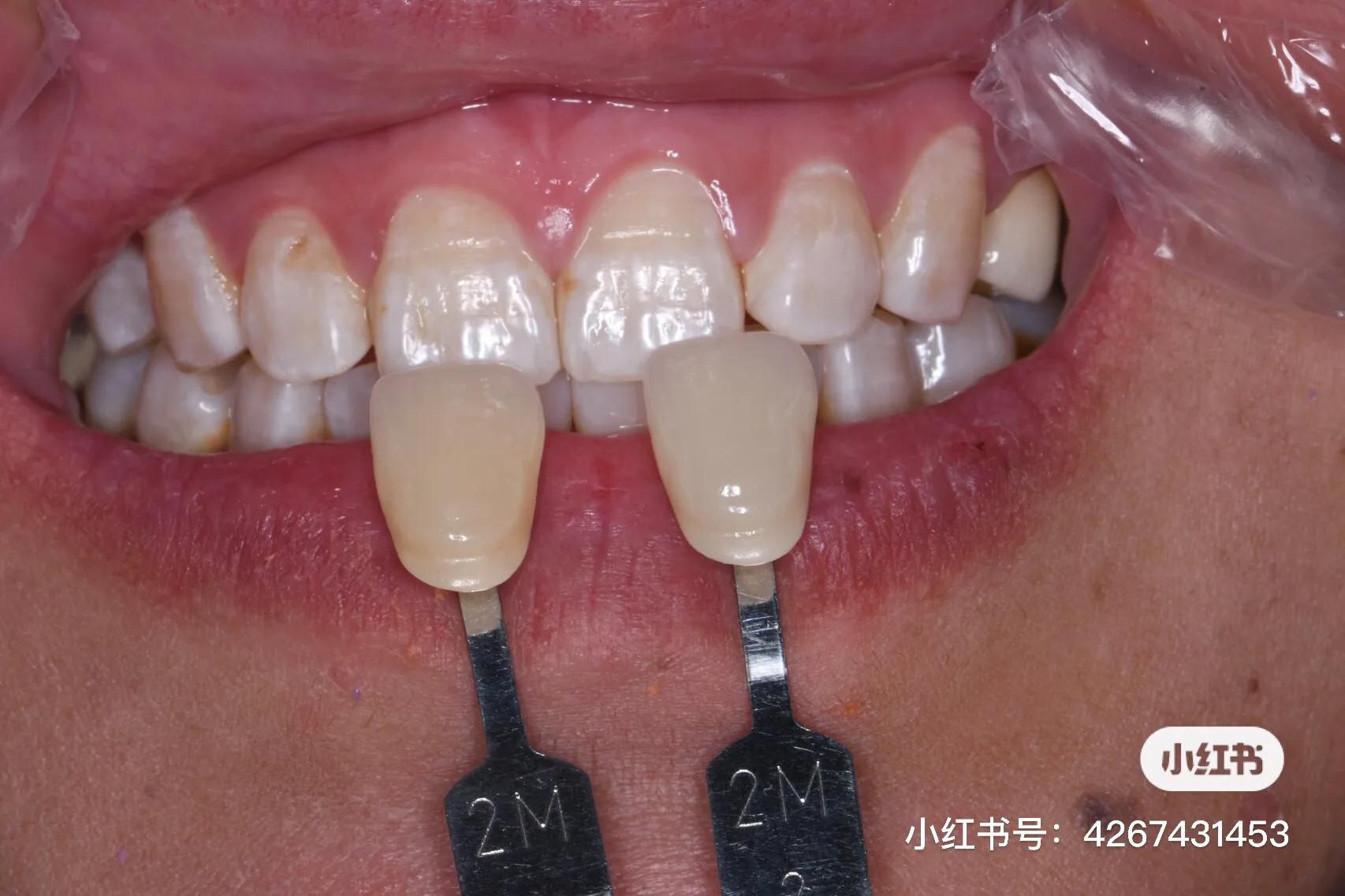 断牙修复,断牙修复病历