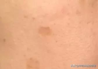 为什么用美白精华皮肤变白,为什么用了美白护肤品反而变黑了