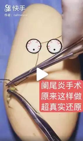 香蕉割包皮，洋葱剖腹产？这是我见过最秀的医生