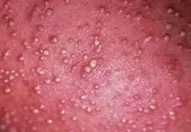 新生儿痱子怎么治好得快,新生儿痱子的最佳治疗方法