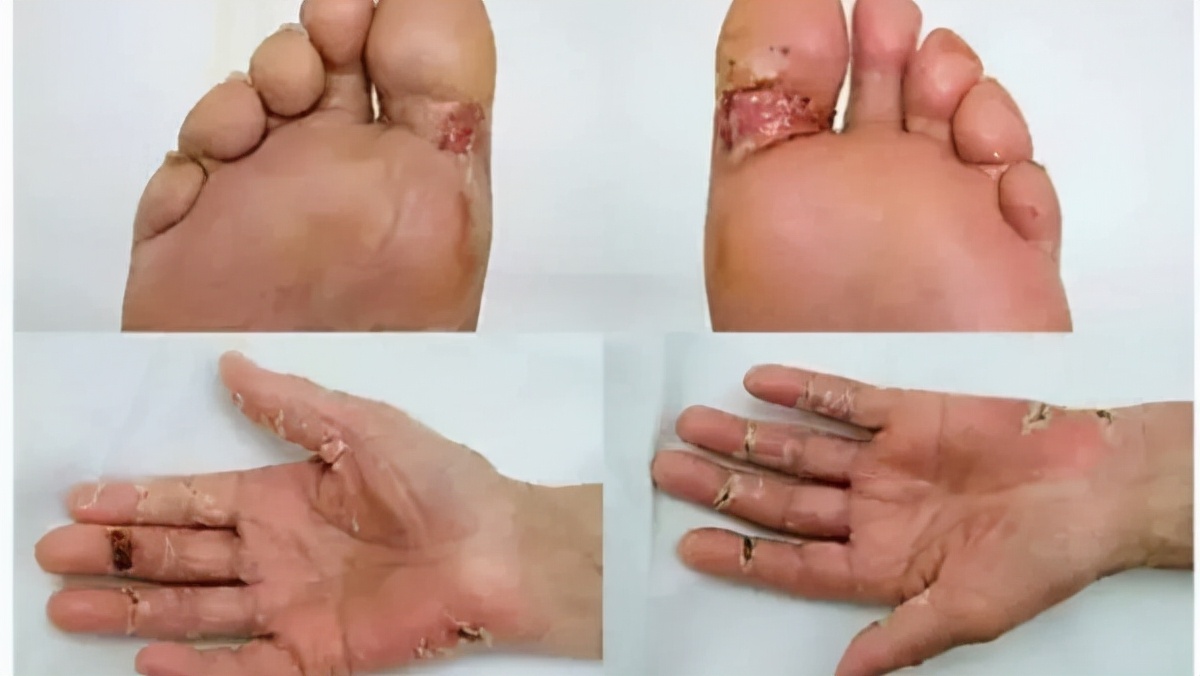 服用靶向药腹泻皮疹吃什么药好,靶向药引起腹泻中医治疗