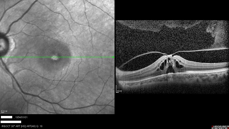 眼球晶体破洞,眼球裂缝是什么原因造成的