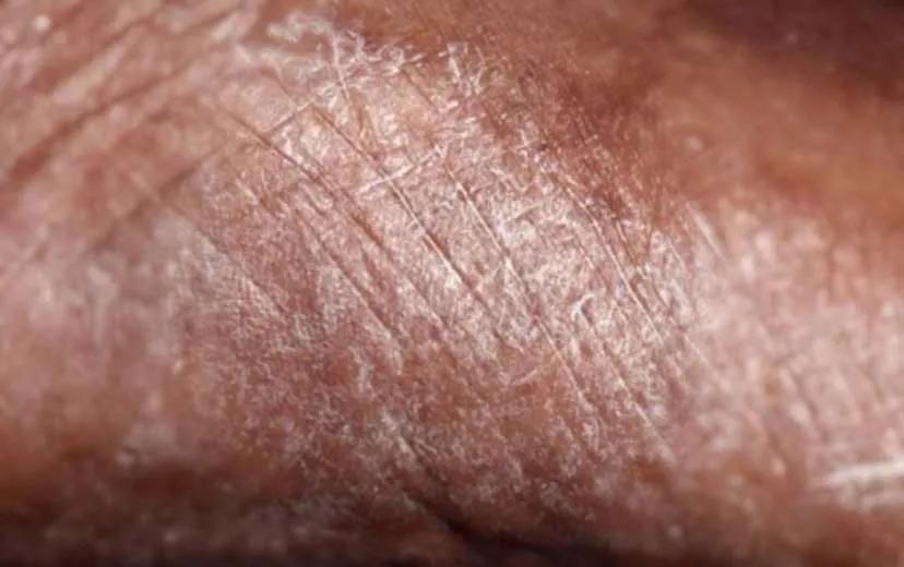 冀连梅治脚气最佳方法,用这个小方法彻底根治脚气