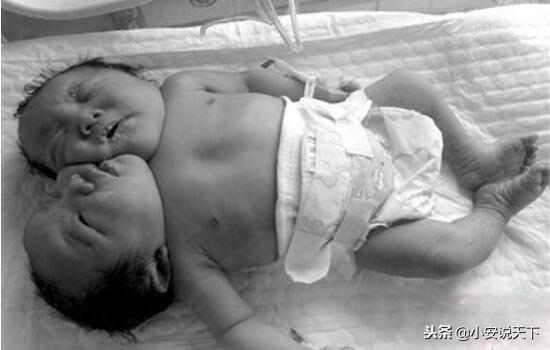 巴西双头婴儿,巴西双头婴儿后续