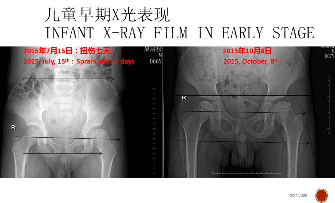 对股骨头缺血性坏死疼痛的治疗体会