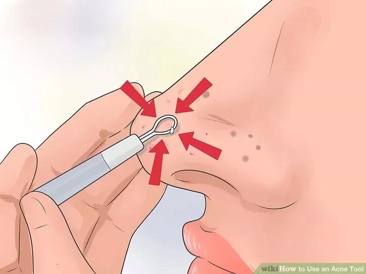 针清祛痘一般多少钱一次,针清祛痘后可以涂甲硝唑吗