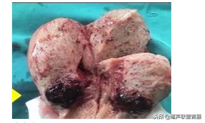 剖宫产疤痕妊娠动画,剖宫产疤痕妊娠的临床分型