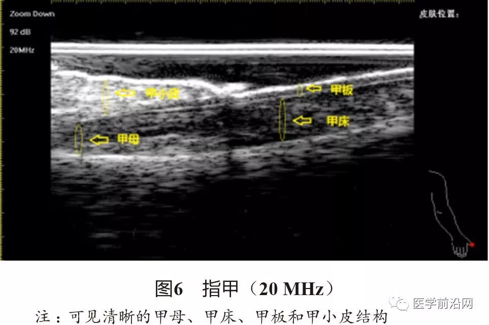 常见皮肤病高频皮肤超声诊断专家共识全文发布