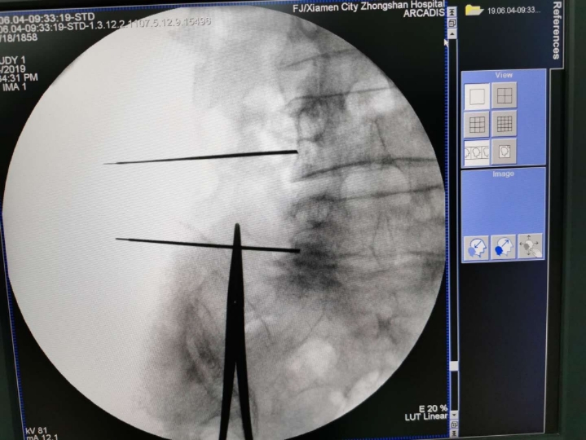 腰痛扎小针刀行吗,腰痛针灸需要吃药嘛