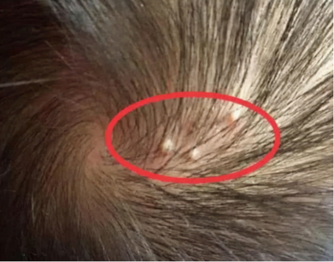 头皮有血疙瘩是什么病,头皮长疙瘩怎么回事怎么解决