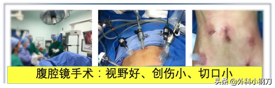 鍖荤敓鍓叉帀澶ц偁,鑲涢棬鍒囬櫎鍚庣画娌荤枟