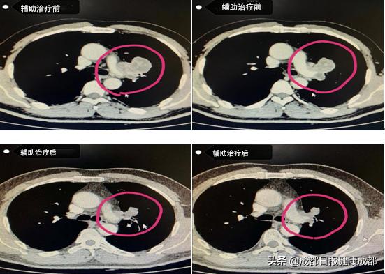 成都哪个医院看肺癌最好,全国肺癌医院排名2023最新排名