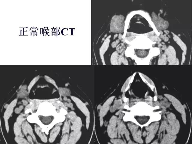 喉部病变做核磁还是ct,耳鼻喉科常见病影像诊断