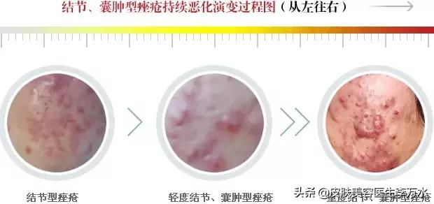 痘痘十大真相,痘痘大全图解