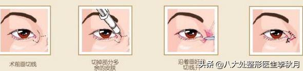 双眼皮刚做完很好看越恢复越难看,双眼皮做完感觉自己睁眼睛不自然
