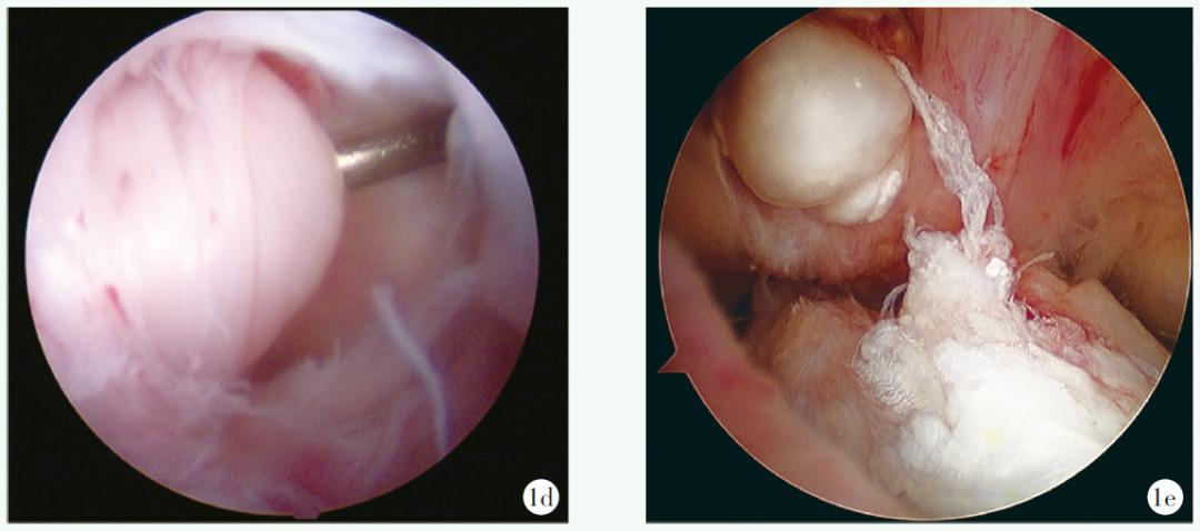 前交叉韧带重建不稳表现,膝盖前交叉韧带重建多久能恢复