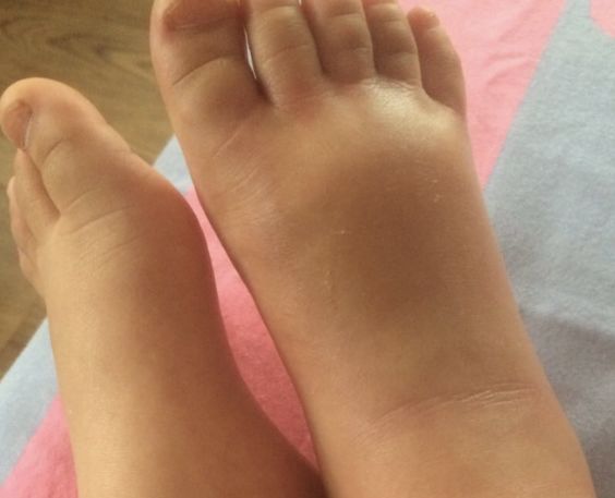 宝宝出去防蚊子叮咬的最佳方法,宝宝一直被蚊子咬怎么驱蚊