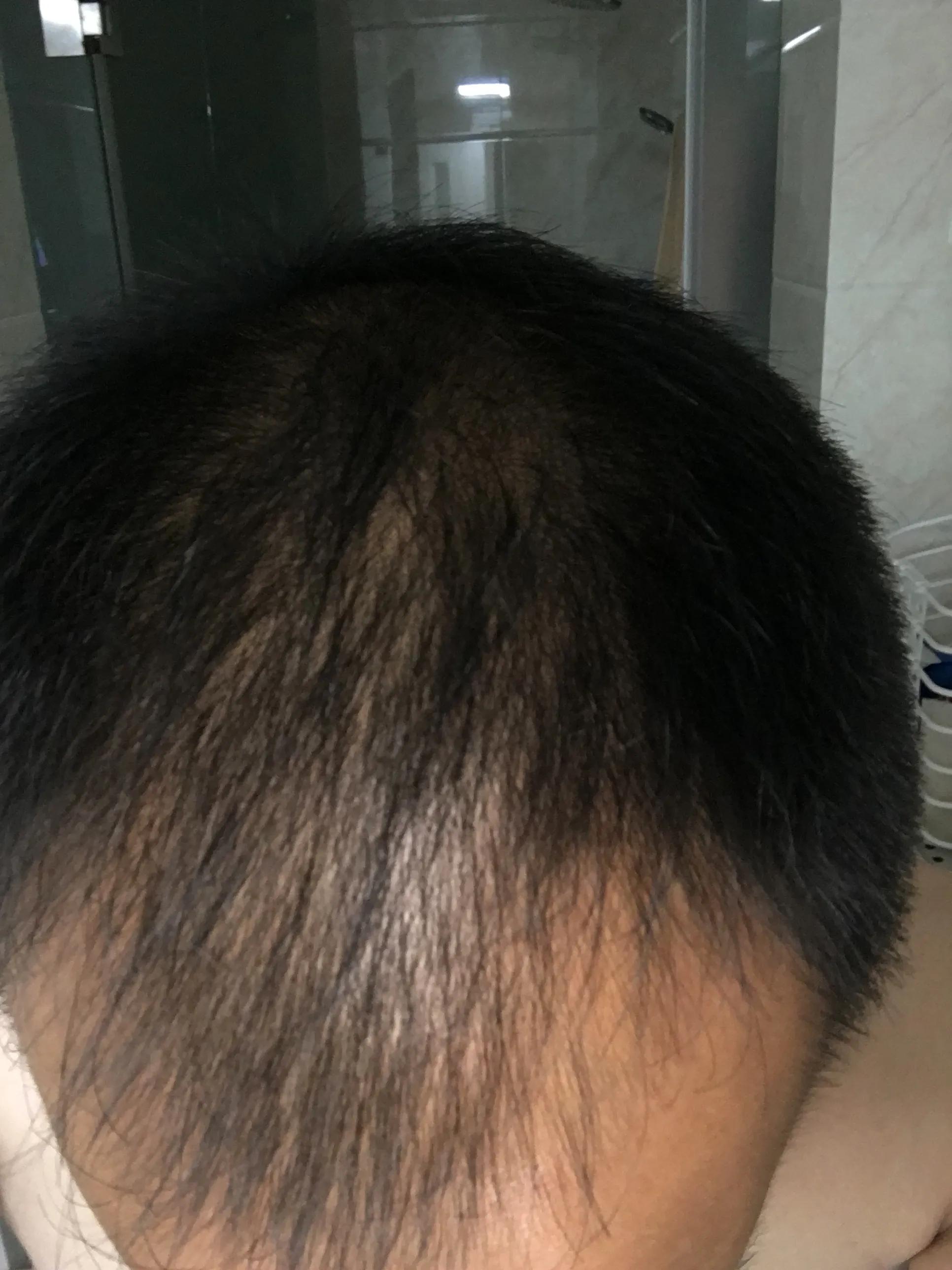 有谁治好了脂溢性脱发,脂溢性脱发用什么洗头