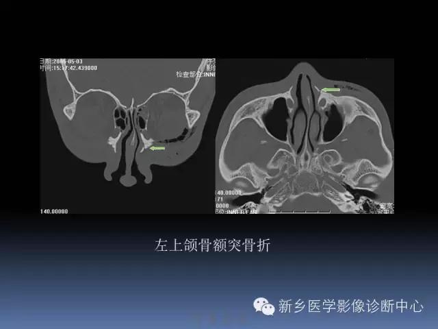 鼻骨骨折在ct片上的表现,鼻骨骨折ct怎么看