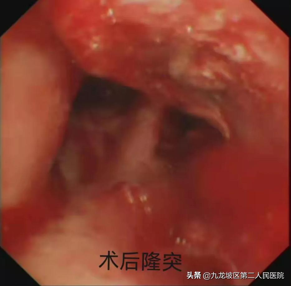 你知道支气管淀粉样变吗？82岁大爷在手术台上竖起了大拇指