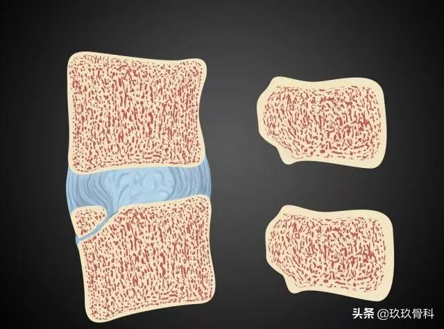 病例实讲|你是否也将其误诊为椎体骨折