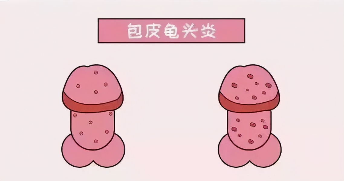 割包皮和不割包皮的区别,割包皮最好是成年前还是成年后割