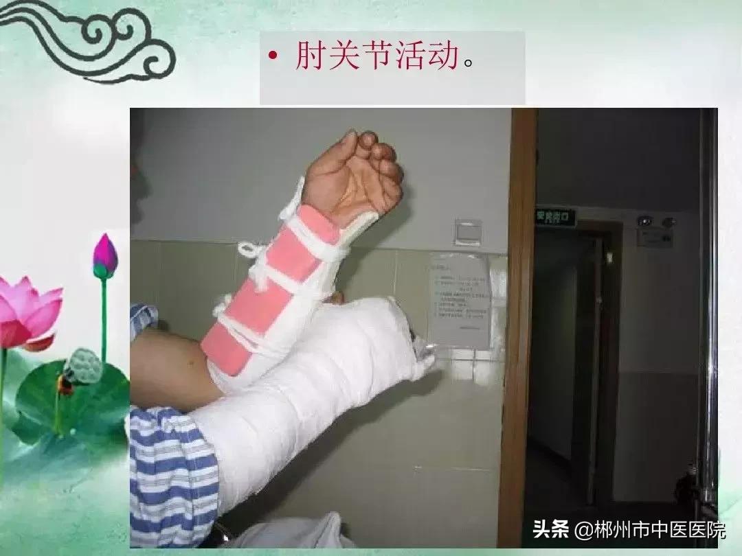 骨折后小夹板固定,骨折小夹板固定方法实操